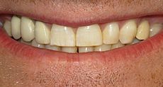 Mild dental fluorosis image