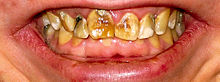 Severe dental fluorosis image